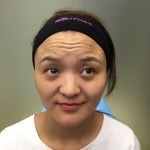 注射去皱纹|去抬头纹对比照片真实案例分享