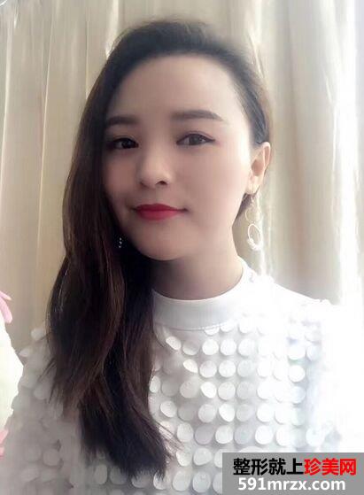 注射去皱纹|去抬头纹对比照片真实案例分享