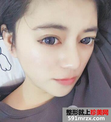 耳软骨垫鼻尖|鼻尖美容术案例前后对比效果图