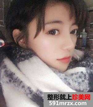 耳软骨垫鼻尖|鼻尖美容术案例前后对比效果图