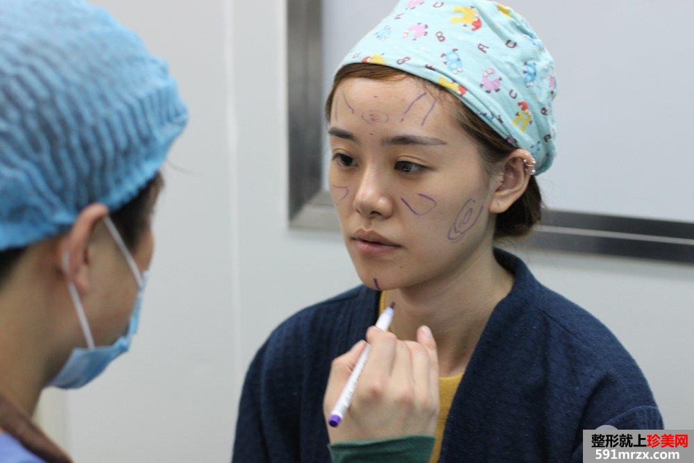 自体脂肪面部填充恢复全过程前后对比照片真人案例
