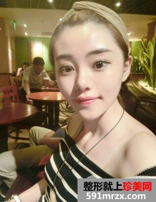 自体脂肪面部填充恢复全过程前后对比照片真人案例
