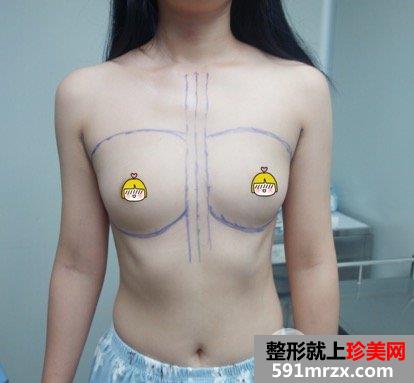 自体脂肪丰胸真实案例前后对比图，摇身一变性感美女