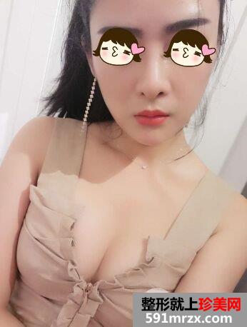 自体脂肪丰胸真实案例前后对比图，摇身一变性感美女