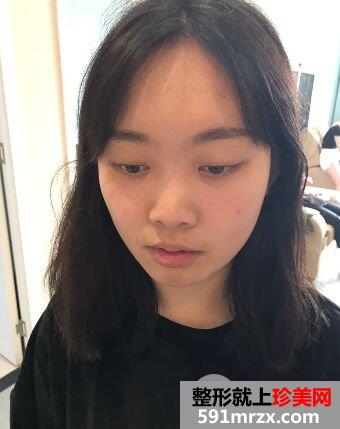 鼻综合整形+假体垫下巴真人日记完美蜕变对比照