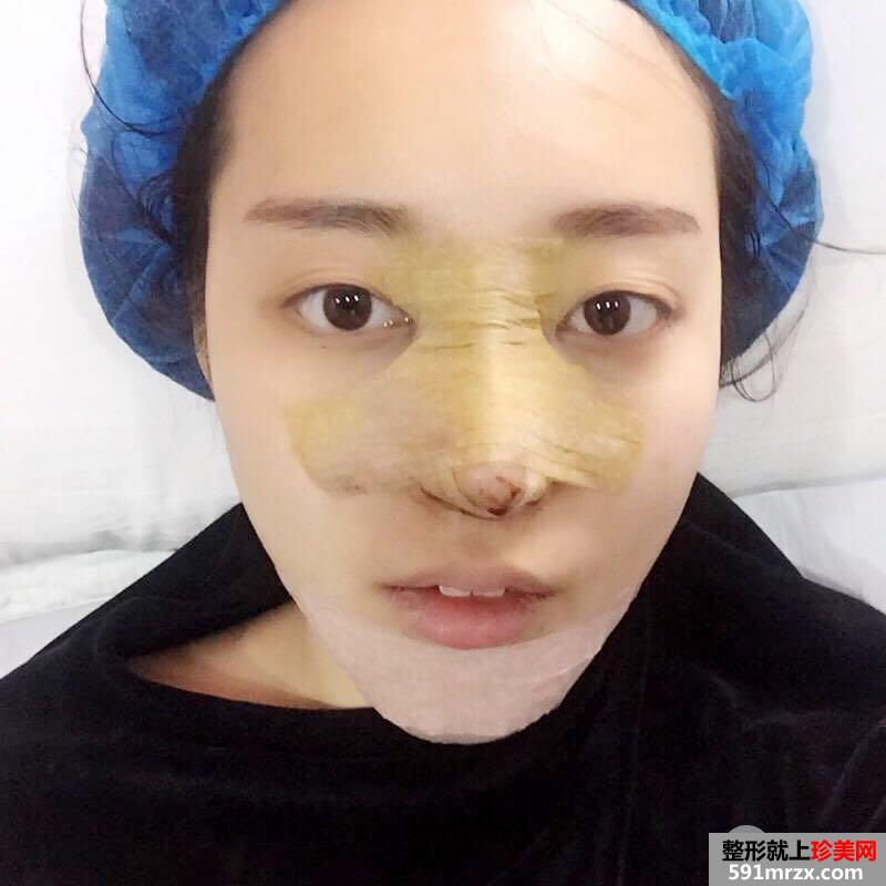 鼻综合整形+假体垫下巴真人日记完美蜕变对比照