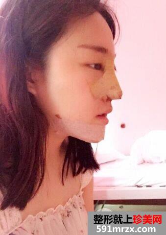 鼻综合整形+假体垫下巴真人日记完美蜕变对比照