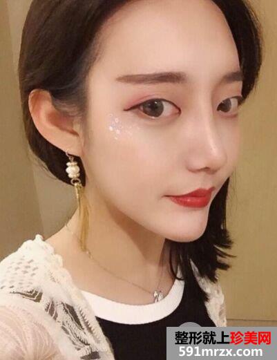 鼻综合整形+假体垫下巴真人日记完美蜕变对比照