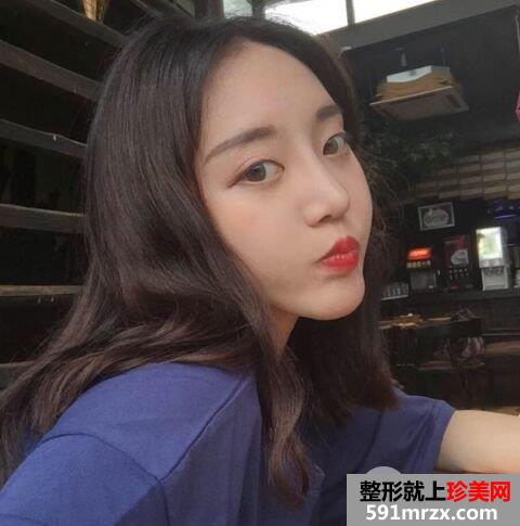 鼻综合整形+假体垫下巴真人日记完美蜕变对比照
