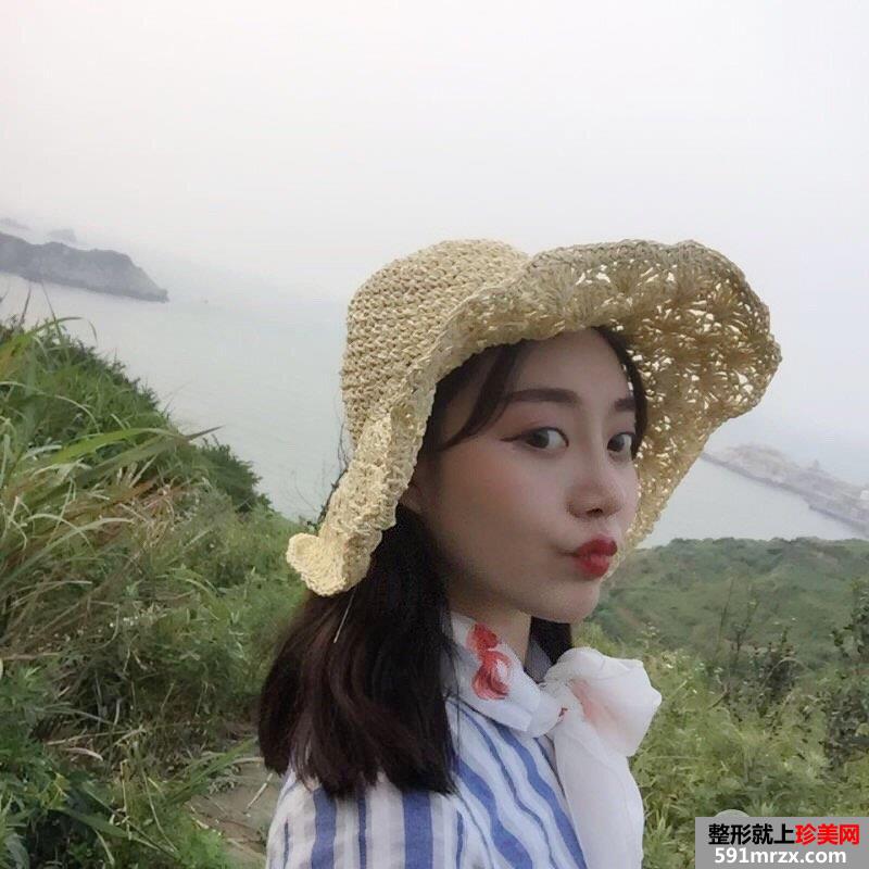 鼻综合整形+假体垫下巴真人日记完美蜕变对比照