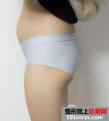 腰腹吸脂手术恢复效果对比照片摆脱“游泳圈”