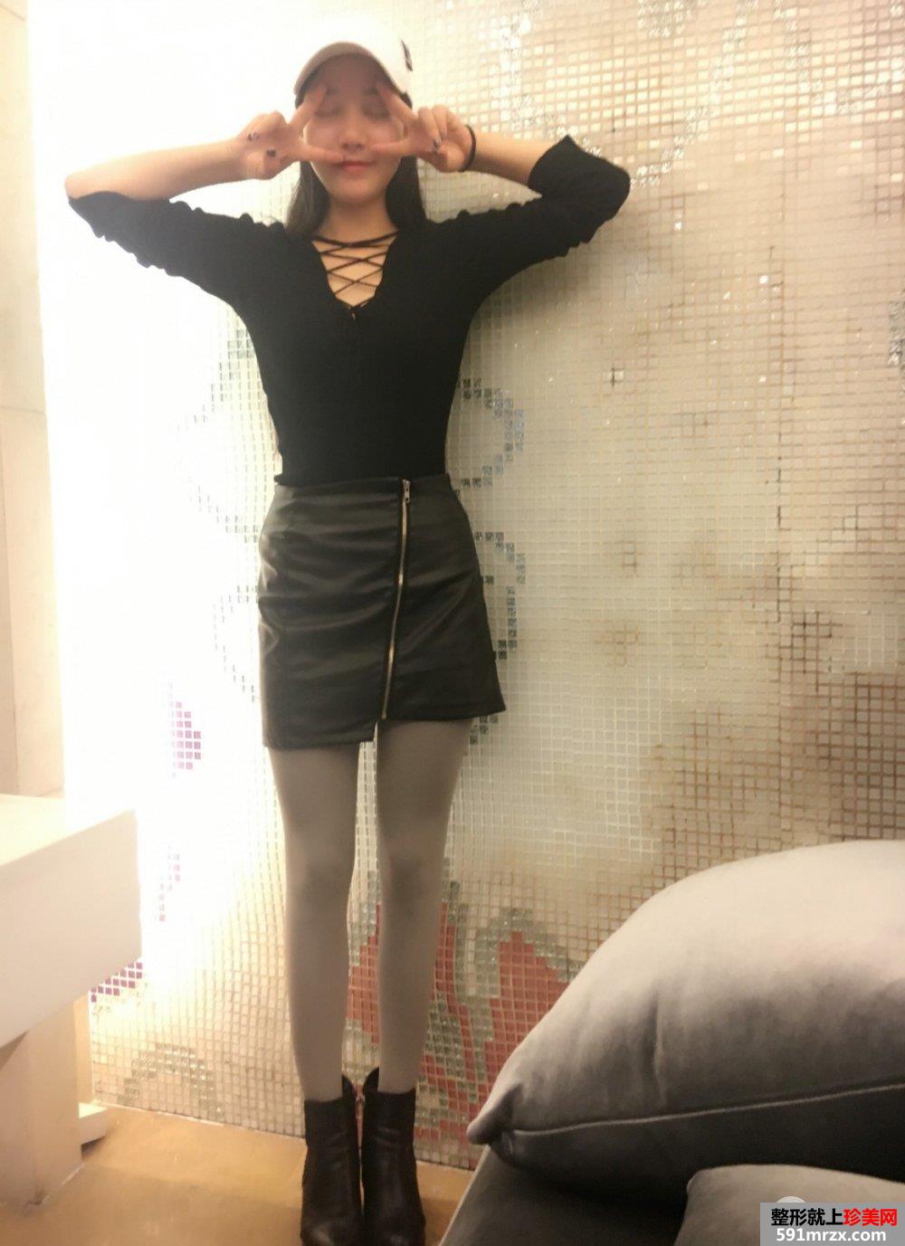 腰腹吸脂手术恢复效果对比照片摆脱“游泳圈”