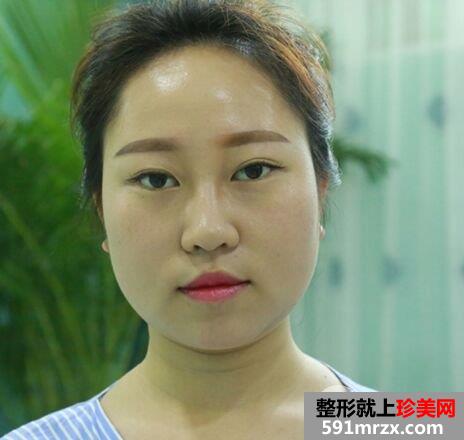 溶脂术|激光溶脂瘦脸真实案例分享，鹅蛋脸get