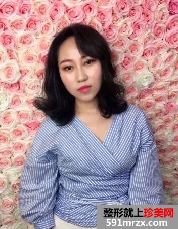 溶脂术|激光溶脂瘦脸真实案例分享，鹅蛋脸get