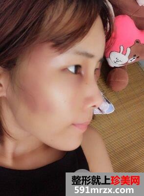 自体脂肪面部填充面部精雕真实案例打造童颜美女