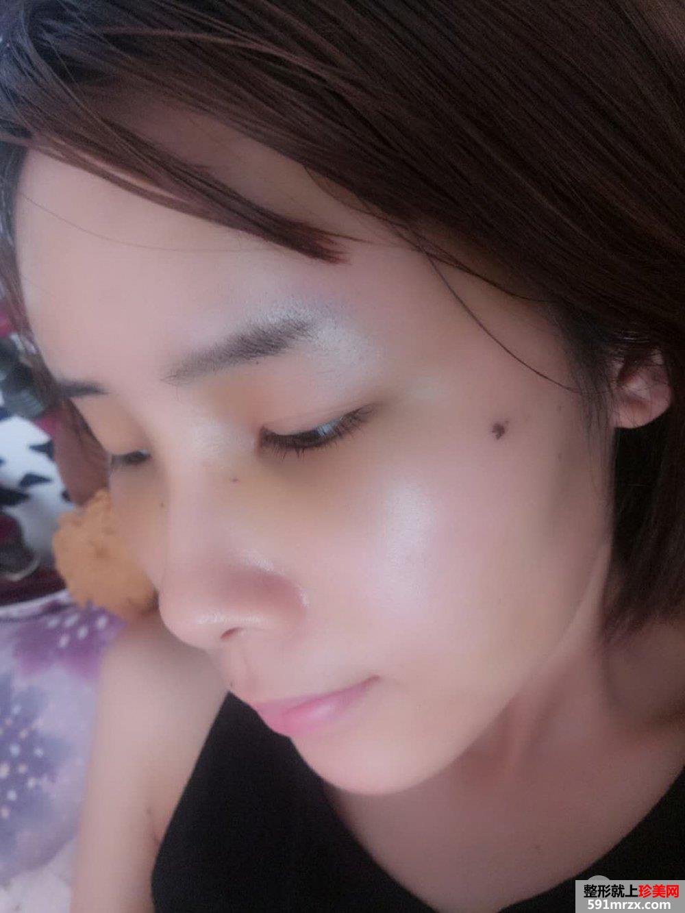 自体脂肪面部填充面部精雕真实案例打造童颜美女