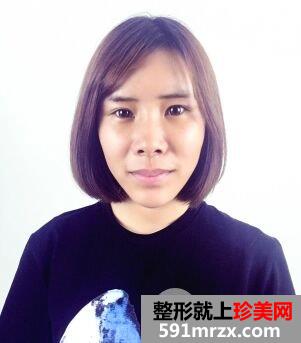自体脂肪面部填充面部精雕真实案例打造童颜美女