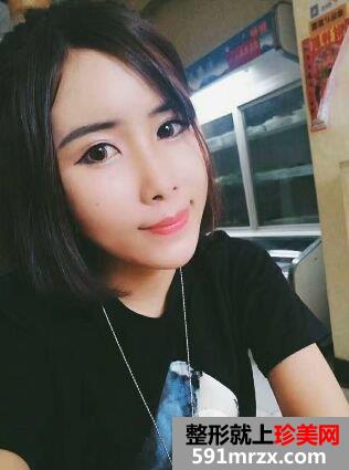 自体脂肪面部填充面部精雕真实案例打造童颜美女