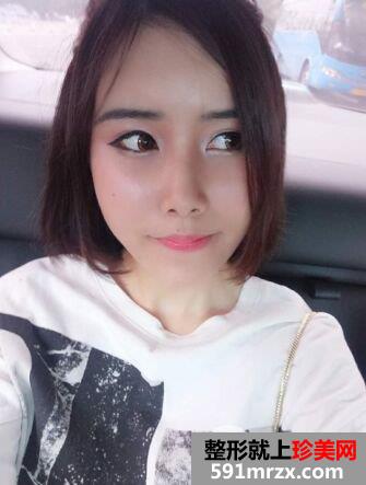 自体脂肪面部填充面部精雕真实案例打造童颜美女