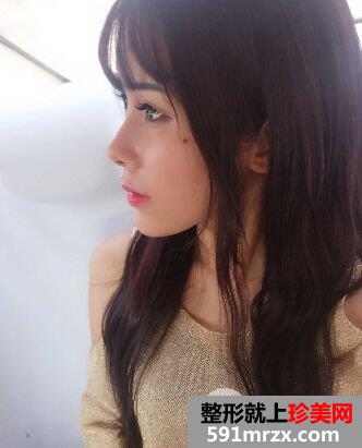 自体脂肪面部填充面部精雕真实案例打造童颜美女