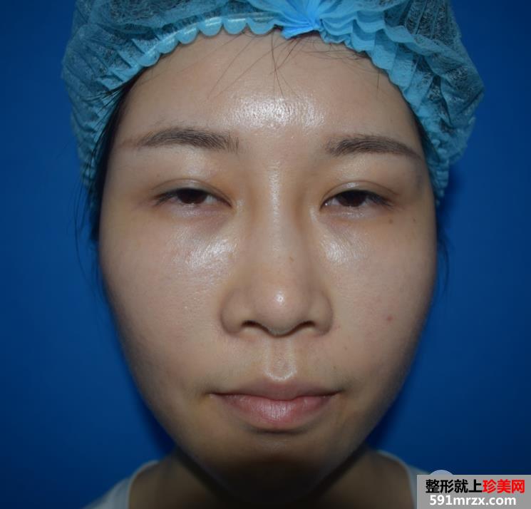 外眼角开大真实案例分享，开眼角前后对比照片