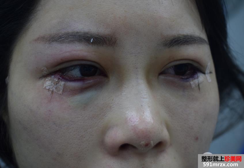 外眼角开大真实案例分享，开眼角前后对比照片