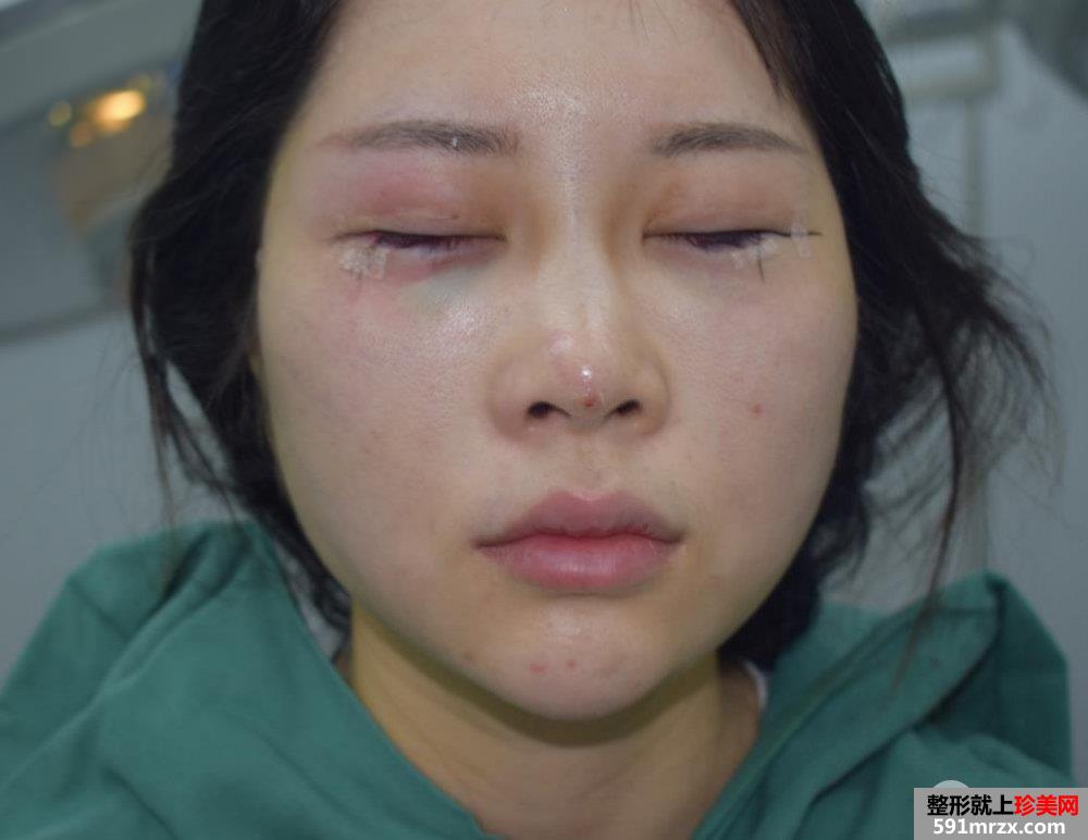 外眼角开大真实案例分享，开眼角前后对比照片