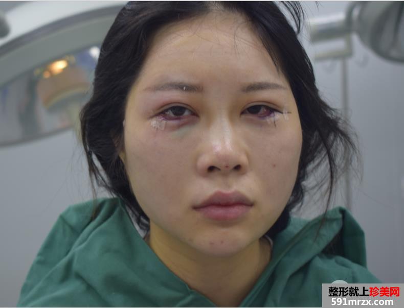 外眼角开大真实案例分享，开眼角前后对比照片