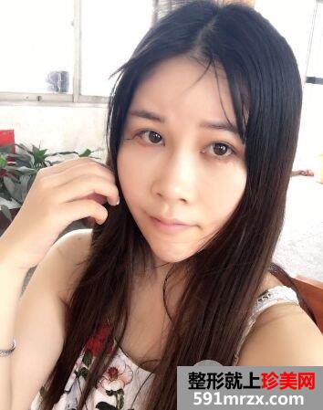外眼角开大真实案例分享，开眼角前后对比照片