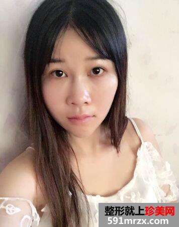 外眼角开大真实案例分享，开眼角前后对比照片