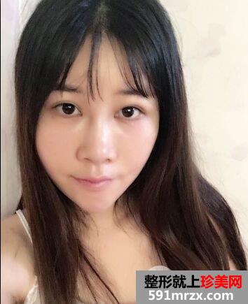 外眼角开大真实案例分享，开眼角前后对比照片