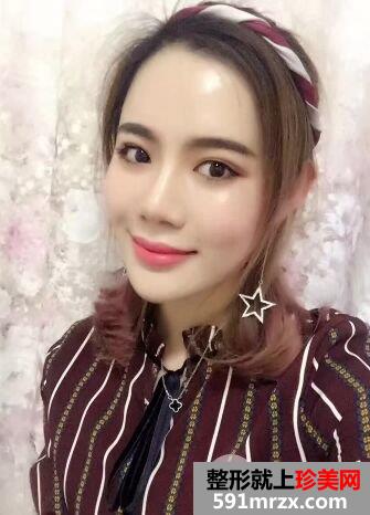 石家庄蓝山整形价格表自体脂肪面部填充价格案例照片分享