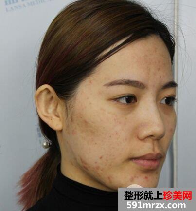石家庄蓝山整形价格表自体脂肪面部填充价格案例照片分享