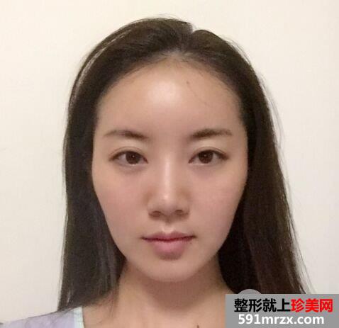 北京八大处整形价格表|自体脂肪面部填充惊人效果对比照片