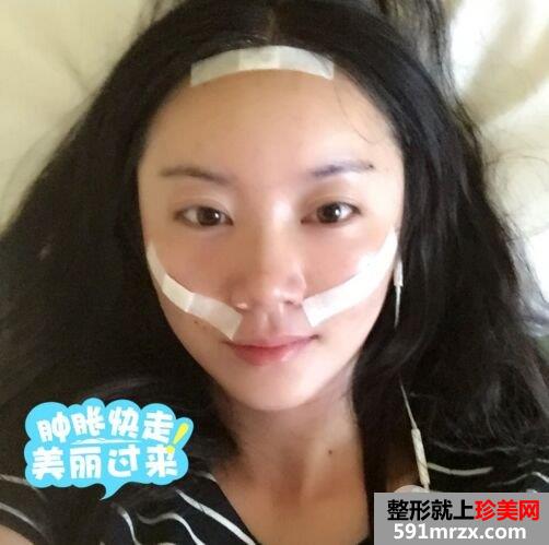 北京八大处整形价格表|自体脂肪面部填充惊人效果对比照片