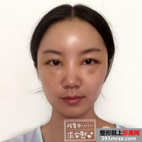 北京八大处整形价格表|自体脂肪面部填充惊人效果对比照片