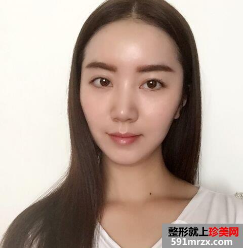 北京八大处整形价格表|自体脂肪面部填充惊人效果对比照片