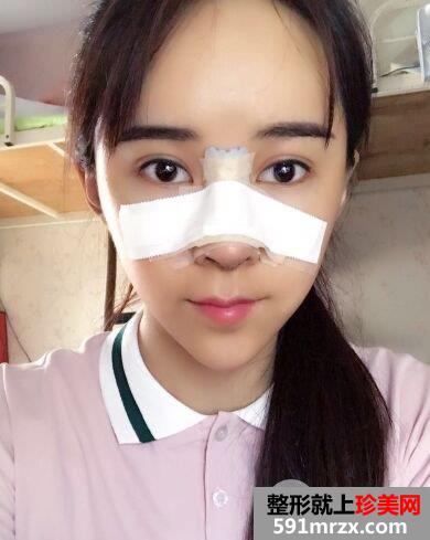 深圳艾妍整形价格表|隆鼻失败修复手术案例效果图