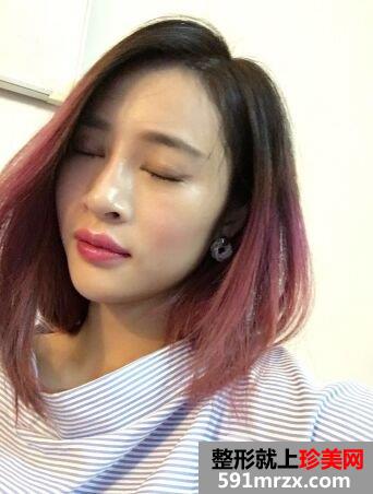  深圳晨曦整形价格表|双眼皮失败修复真实案例恢复照片