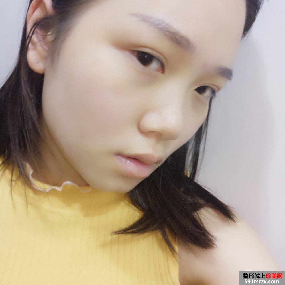 南宁韩成故事整形价格表瘦脸针去咬肌真实案例效果