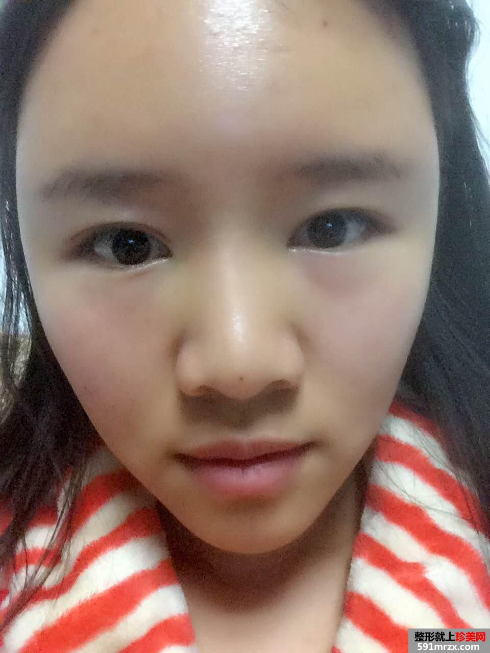 北京东方和谐整形价格表|自体脂肪面部填充价格真实案例照片分享