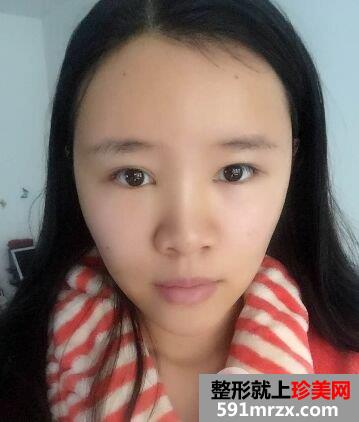 北京东方和谐整形价格表|自体脂肪面部填充价格真实案例照片分享