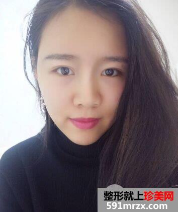 北京东方和谐整形价格表|自体脂肪面部填充价格真实案例照片分享