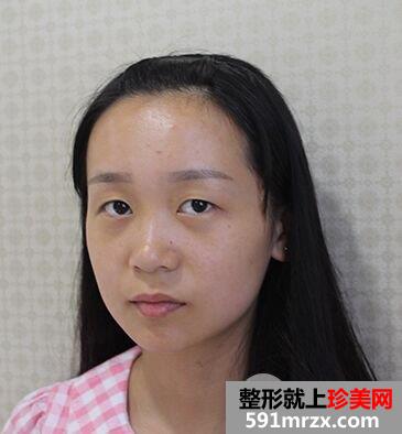 长沙美研整形价格表|拉双眼皮手术真实案例效果对比分享