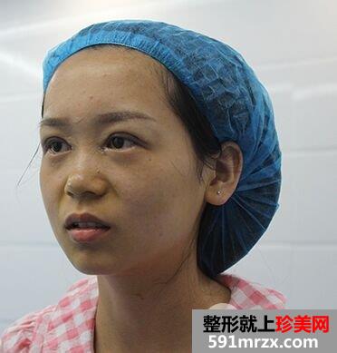 长沙美研整形价格表|拉双眼皮手术真实案例效果对比分享