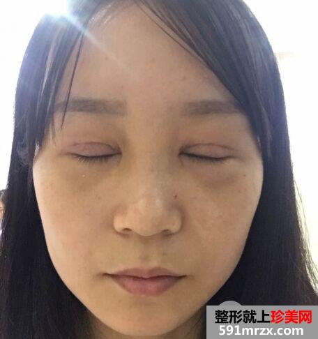 长沙美研整形价格表|拉双眼皮手术真实案例效果对比分享
