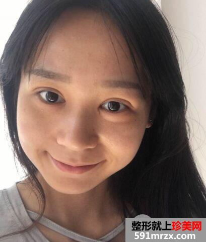 长沙美研整形价格表|拉双眼皮手术真实案例效果对比分享