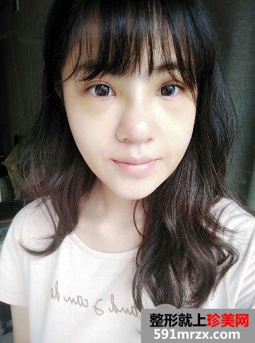 成都军大整形价格表|鼻头缩小术要多少钱及手术案例分享