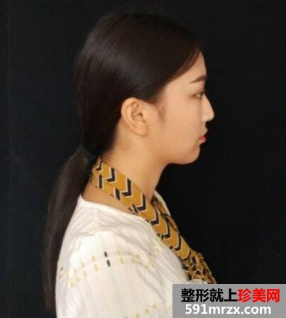 武汉新至美整形价格表|隆下颌真实案例立现鹅蛋脸