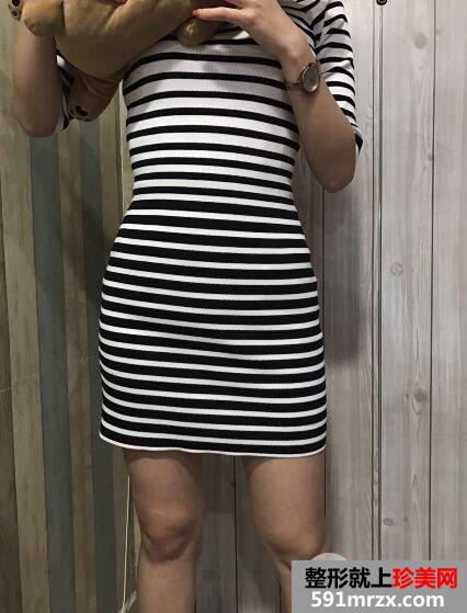 深圳臻瑞芝美整形价格表|腰腹吸脂真实案例小蛮腰立现